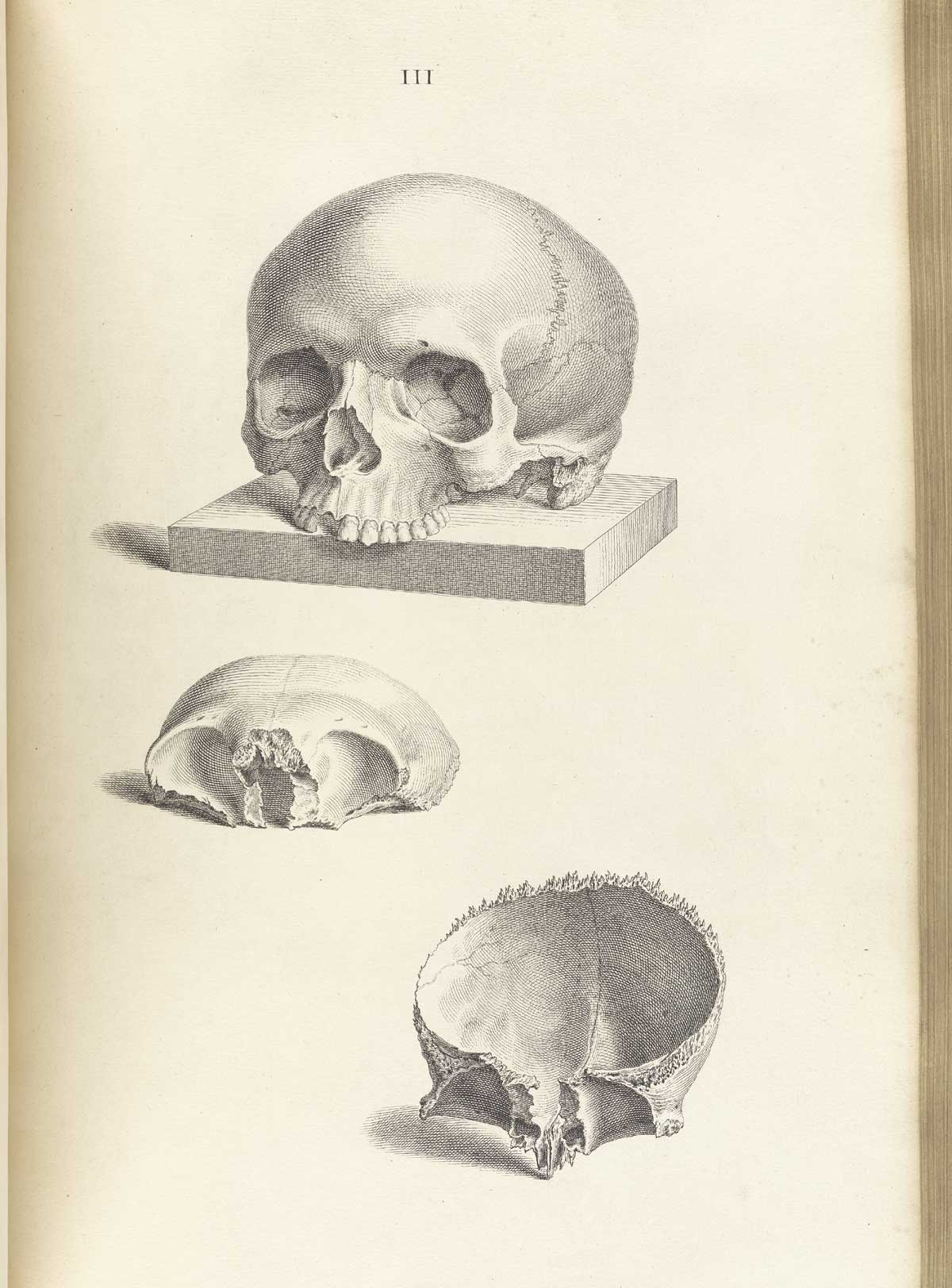 Engraving of a human skull without mandible on a wooden plank at top of the image and two frontal bones below, the first face up showing the exterior and the other face down, giving a view of the interior, from William Cheselden’s Osteographia, NLM Call no.: WZ 260 C499o 1733.