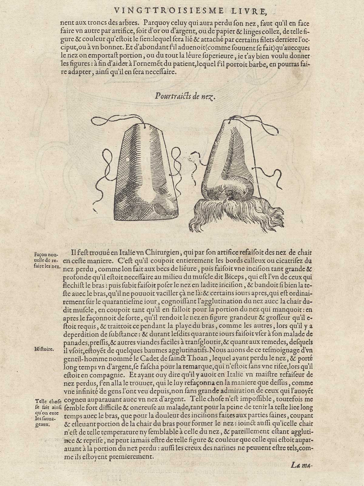 Woodcut of two prosthetic noses, the one on the right with a moustache, with typeset text in French above and below it, from Ambroise Paré’s Oeuvres, NLM Call no.: WZ 240 P227 1585.