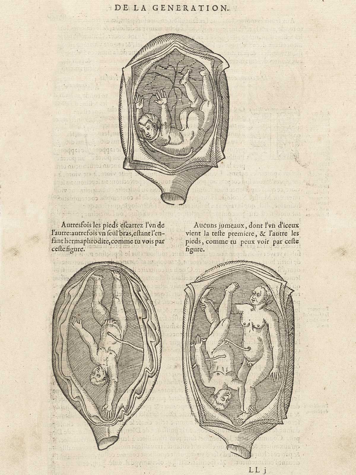 Three woodcuts of fetuses in utero; the top shows the child facing downward toward the cervix; the bottom left show the child as if doing a handstand toward the cervix; and the bottom right shows twins; with typeset text in French half way down the page; from Ambroise Paré’s Oeuvres, NLM Call no.: WZ 240 P227 1585.
