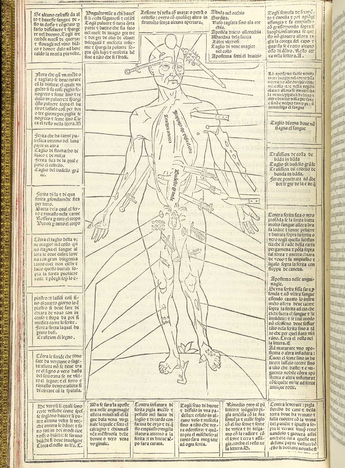 Page 24 of Johannes de Ketham's Fasiculo de medicina, featuring wound man, detailing wounds from swords, daggers, and arrows, and blows from rocks and clubs, as well as knife wounds from domestic and occupational accidents.