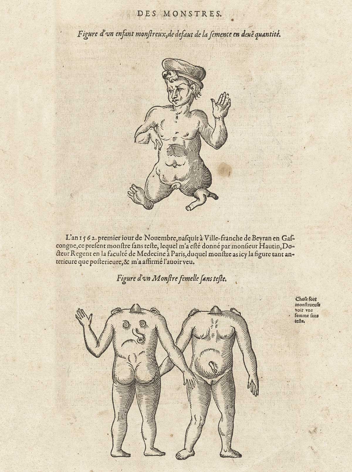 Two woodcuts of monstrous humanoid creatures; the one above is a male dwarf facing and standing whose right foot looks like it is two small legs; the one below is a set of front and back views of a female creature with no head but eyes and nose on the back; with typeset French text between images; from Ambroise Paré’s Oeuvres, NLM Call no.: WZ 240 P227 1585.