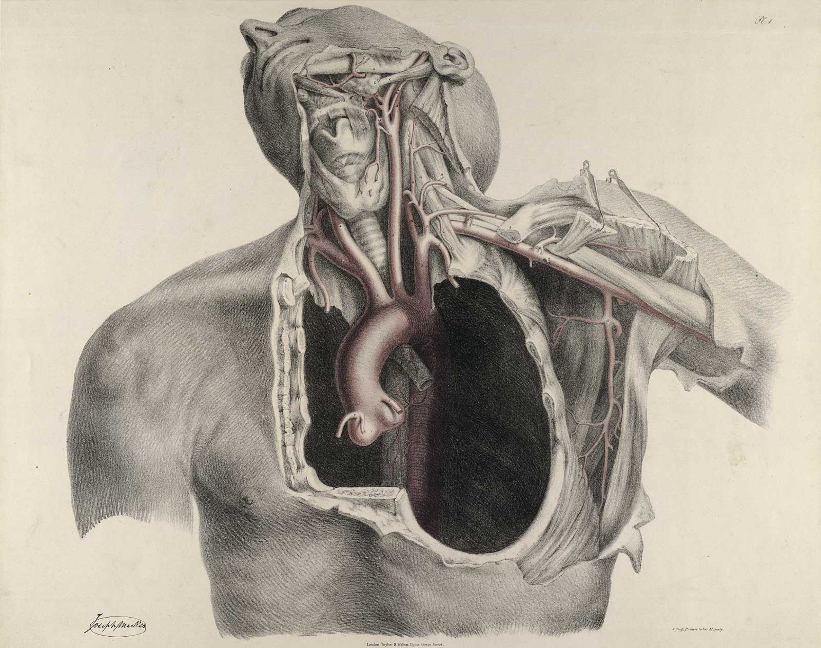 Plate 1 of Quain's The anatomy of the arteries of the human body, with its applications to pathology and operative surgery, featuring the upper body of a male corpse with the head tilted back to the right. The chest cavity has been removed to show the vascular system leading to the head.
