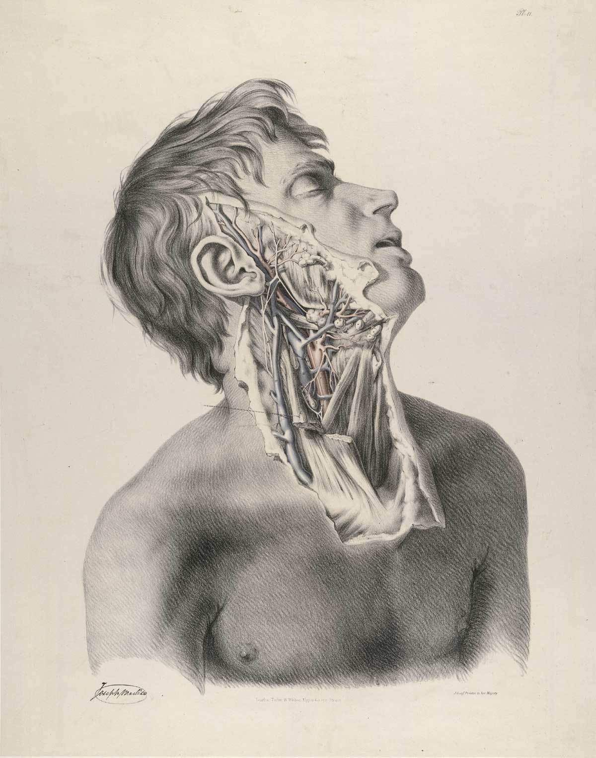 Plate 11 of Quain's The anatomy of the arteries of the human body, with its applications to pathology and operative surgery, featuring the right side view of the flayed body of a male corpse from the neck to the middle of his cheek displaying the muscles, nerves and arteries of the neck and face.