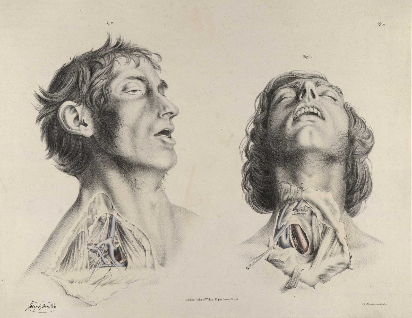 Plate 17 of Quain's The anatomy of the arteries of the human body, with its applications to pathology and operative surgery, featuring the two views of the right side of his neck arteries. The left image is from the right side and the right image is from a frontal view.