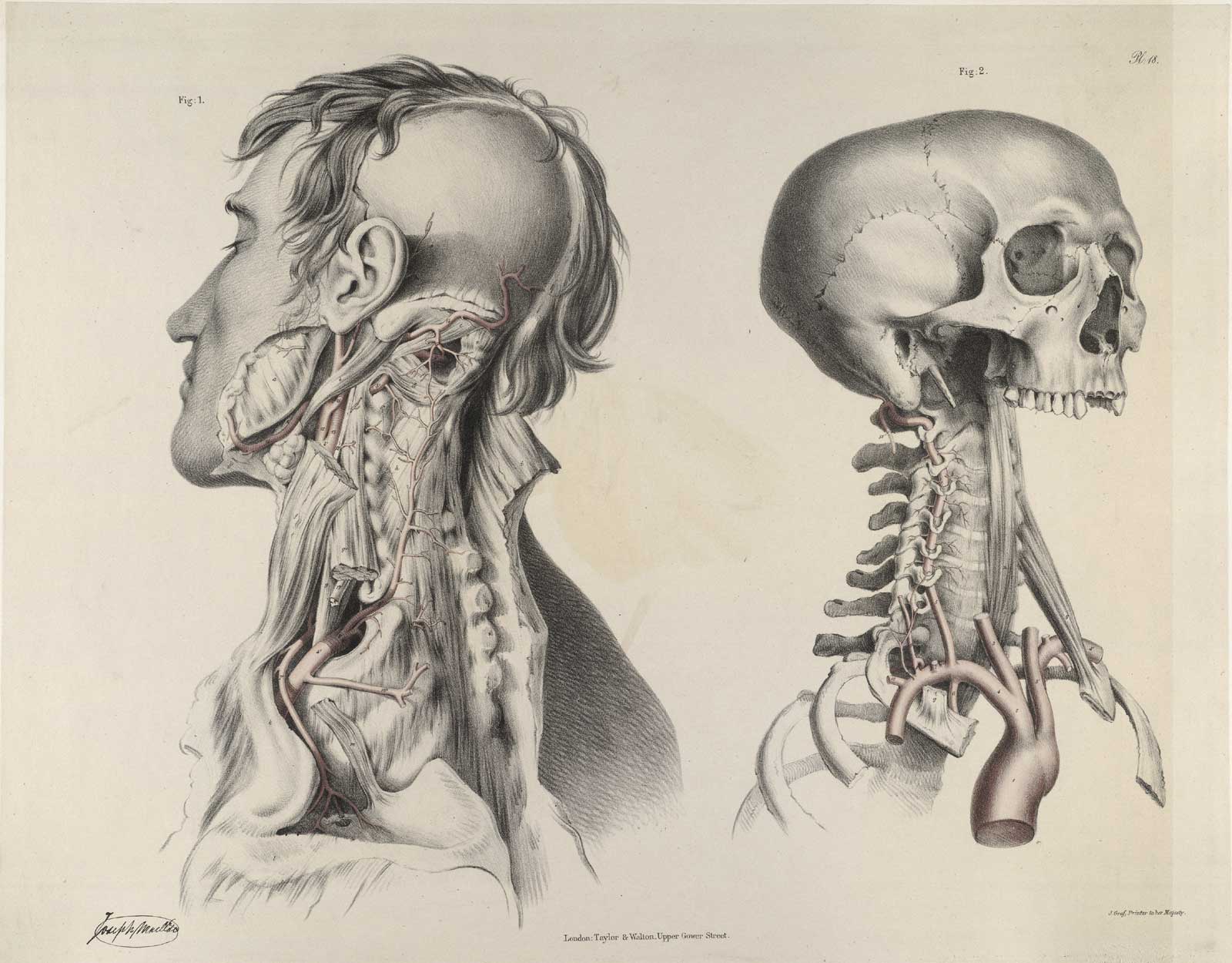 Plate 18 of Quain's The anatomy of the arteries of the human body, with its applications to pathology and operative surgery, featuring two views of the arteries of the neck. The left view is a flayed male corpse from the middle of the vertebra to the side of the face, while the right view is the arterties running through the bones of neck and head.