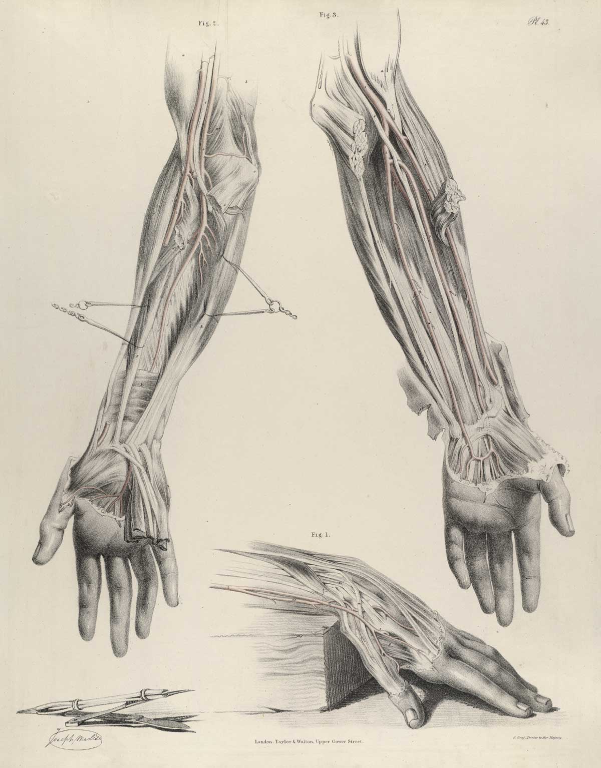 Plate 43 of Quain's The anatomy of the arteries of the human body, with its applications to pathology and operative surgery, featuring three images of the lower arm and hand of a corpse. The left image details the right arm with its arteries and muscles, the right image is of the left arm with its arteries and muscles, while the bottom image is the top view of the wrist and hand detailing the arteries and muscles.