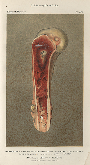 Color illustration of a segement of bone with a bullet wound and an infection.