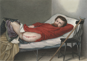 Color illustration of a man, dressed in a red shirt, lying on a bed recovering from the amputation of his leg. The wound and stitches from his surgery are featured prominently in the center of the image.