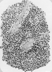 A drawing of an endothelial sarcoma of the dura mater (inner lining of the brain and spinal cord) was made by portrait artist and neurologist Isaac Blackburn.