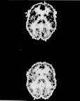 A positron emission tomography (PET) scan of a former opioid addict under the influence of morphine. The bottom scan shows decreased brain activity (lighter tones) as compared to activity in the same brain under the placebo (no drug) above.