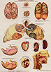 Scientific drawings of the tobacco related diseases effects on the human organs