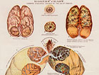 Scientific drawings of the tobacco related diseases effects on the human organs.