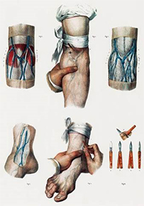 A lithograph of arms and an ankle with visible veins, an arm and a leg wrapped in a tourniquet, and surgical instruments