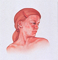 An illustration of a white girl with a rash