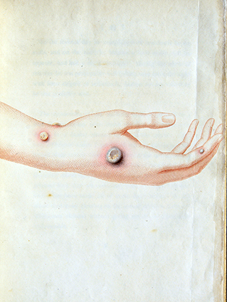 Upper arm of Sarah Nelmes, with five pustules on the eighth day.