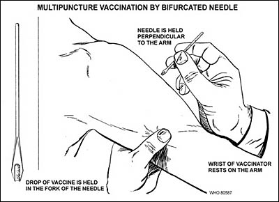 Illustration of a multipuncture vaccination by a bifurcated need. A left hand holds the upper arm while a right hand holds a bifurcated needle perpendicular to the arm.