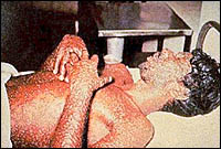 Head and shoulders view of a man lying in a bed covered in smallpox pustules.