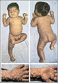 The back of a Smallpox Recognition card featuring four images of a child with smallpox. The top two are the front and back images of a naked child with smallpox pustules cover its body. The bottom two images are the top and bottom detail of the right hand of the child showing the smallpox pustules.