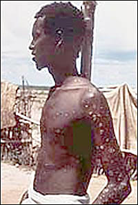 Head and shoulders left pose of Ali Maow Maalin standing showing his naked chest showing his smallpox pustules.