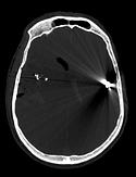 CT section of head wound, 2003