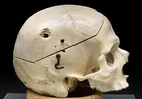 Skull showing gun shot trauma Male profile, 1950s