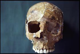 Liliana Pereyra's skull reconstruction, about 1985
