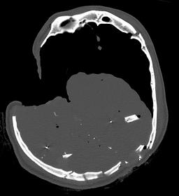 This CT section of a gunshot wound shows bone and bullet fragments in the wound track (see arrow). There is outward beveling at the exit wound of the skull, 2003