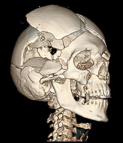 This right anterior view of a three-dimensional CT reconstruction of the bony skull with bullet wounds shows the hole of the exit wound through the right-sided temporal entrance wound, 2003