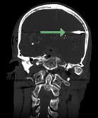 Coronal CT reformation showing the projectile on the left (arrow)