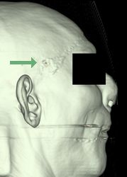 3D CT surface reconstruction of the face showing a small entrance wound of the right temple (arrow)
