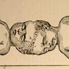 Nineteenth century drawing of twins joined at the crowns of their heads.