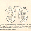 Nineteeth century illustration of Chang and Eng Bunker’s livers and shared hepatic vessels, showing how an injection into Chang passed into Eng.