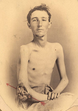 Seated shirtless man faces camera and exposes left gangrenous elbow.