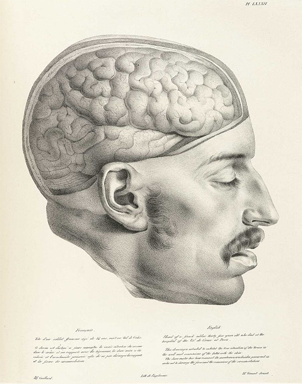 Lithograph of head of French soldier facing right with brain exposed.