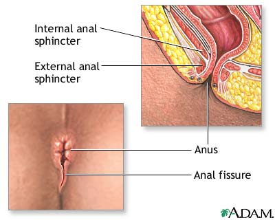 antibiotics and difficile Anal injected
