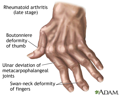 clinical presentations of rheumatoid arthritis