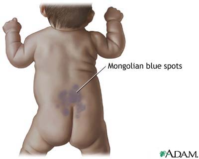 Mongolian blue spots: MedlinePlus Medical Encyclopedia