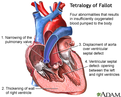 File:Tetralogy of Fallot.svg - Wikimedia Commons