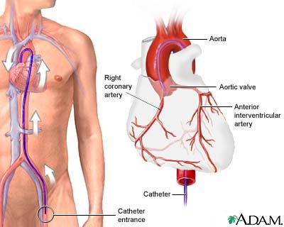 Coronary angiography: MedlinePlus Medical Encyclopedia