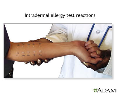 Внутрикожную пробу аллергических реакций