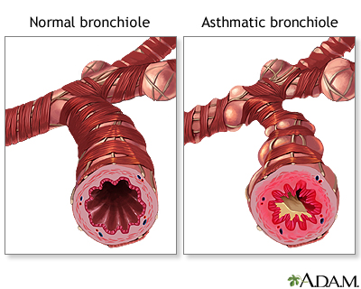 Нормальный против астматических bronchiole