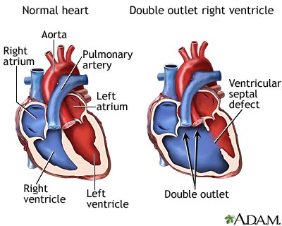 Double outlet right ventricle: MedlinePlus Medical ...