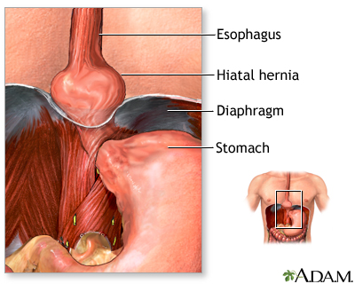 Hiatal hernia repair - series: MedlinePlus Medical Encyclopedia