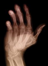 Radiografía de una mano artrítica