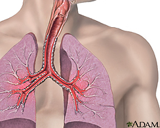 Illustration of asthma