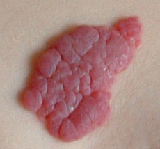 Picture of Cherry Angioma - WebMD