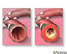 Ilustración de bronquios normales y otros con bronquitis