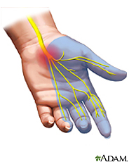 Illustration of the carpal tunnel syndrome