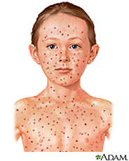 Ilustración de un niño con varicela