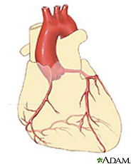Ilustración del corazón mostrando la arteria coronaria derecha